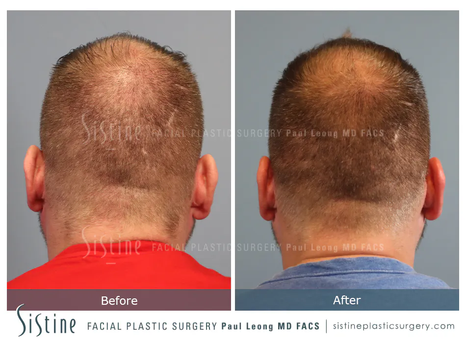 Hair Transplant Before and After | Leong Facial Plastic Surgery
