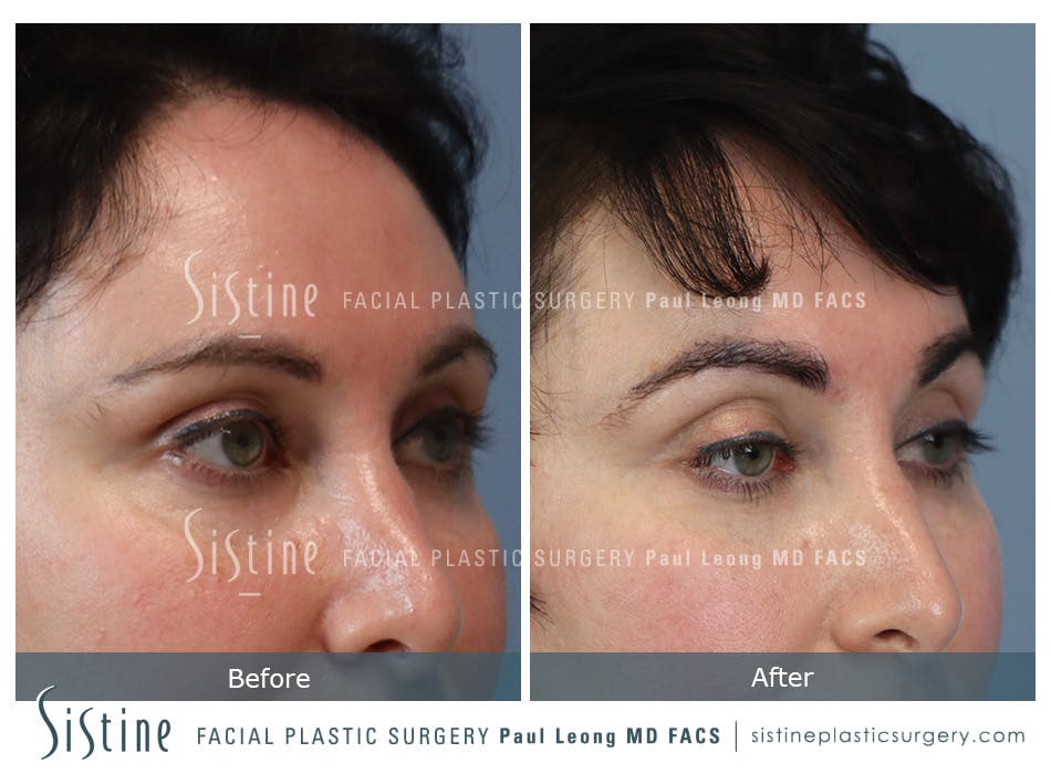 Hair Transplant Before and After | Leong Facial Plastic Surgery