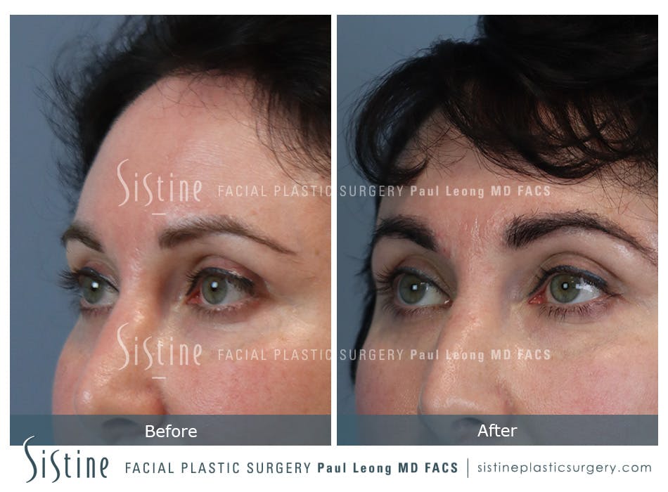 Hair Transplant Before and After | Leong Facial Plastic Surgery