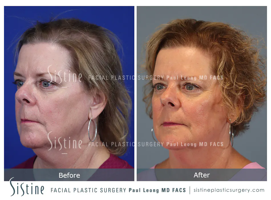 Hair Transplant Before and After | Leong Facial Plastic Surgery