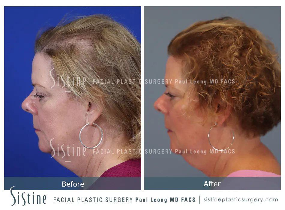 Hair Transplant Before and After | Leong Facial Plastic Surgery