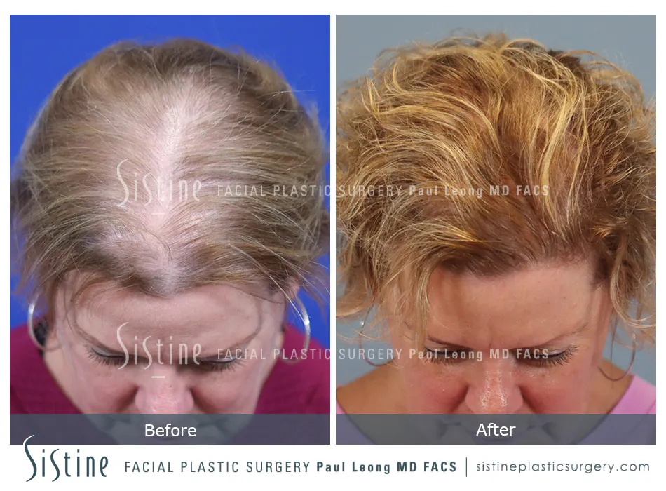 Hair Transplant Before and After | Leong Facial Plastic Surgery