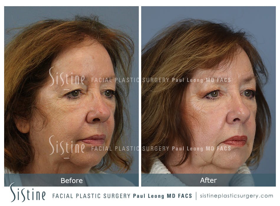 Hair Transplant Before and After | Leong Facial Plastic Surgery