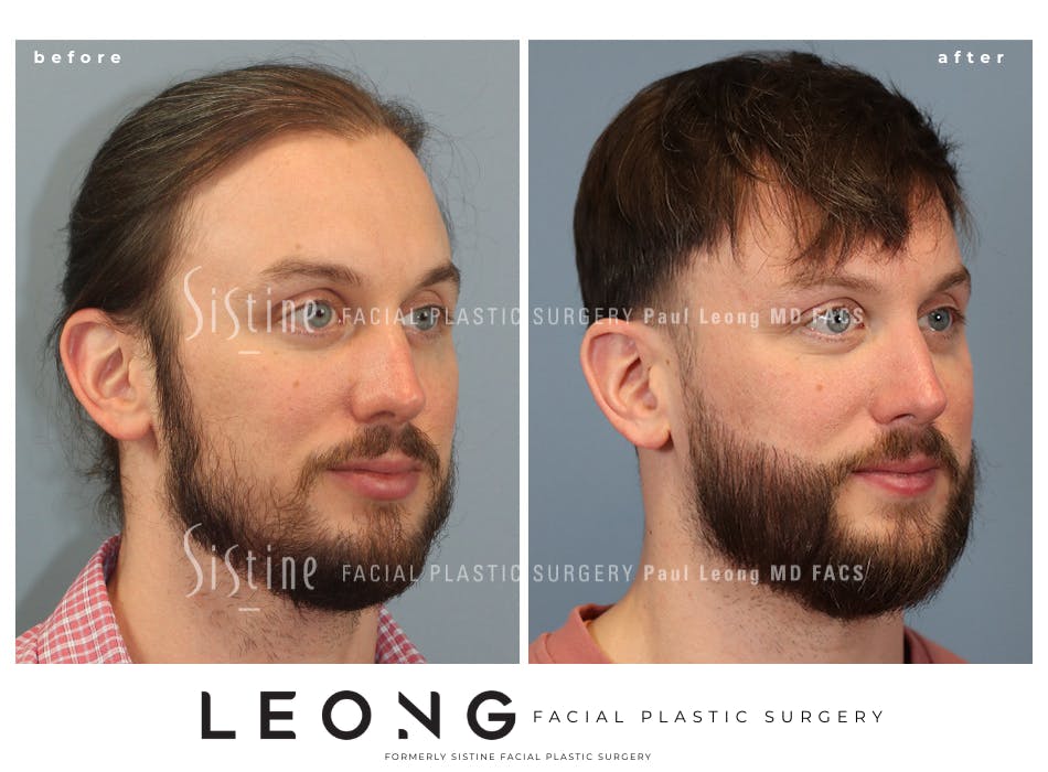 Hair Transplant Before and After | Leong Facial Plastic Surgery