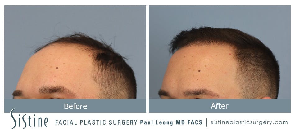 Hair Transplant Before and After | Leong Facial Plastic Surgery