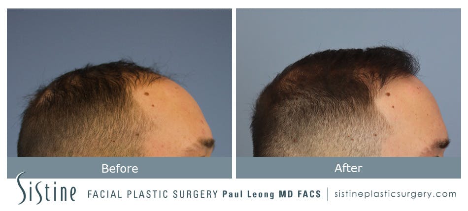 Hair Transplant Before and After | Leong Facial Plastic Surgery