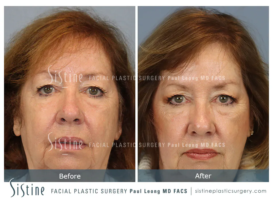 Hair Transplant Before and After | Leong Facial Plastic Surgery