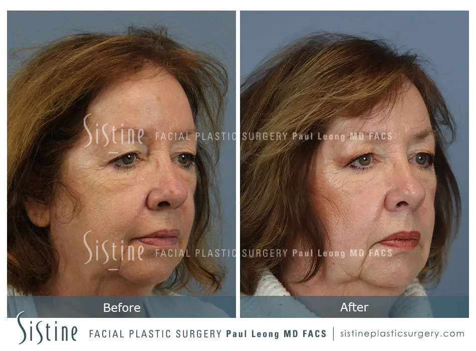 Hair Transplant Before and After | Leong Facial Plastic Surgery