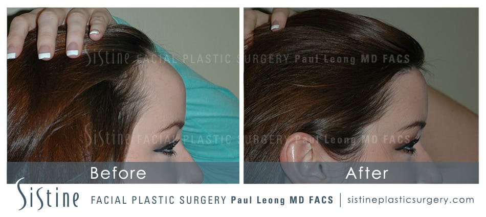Hair Transplant Before and After | Leong Facial Plastic Surgery