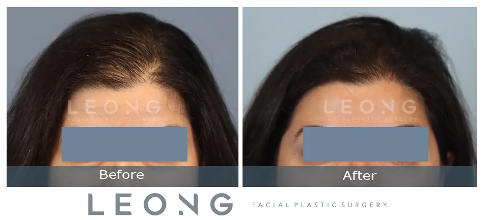 Hair Transplant Before and After | Leong Facial Plastic Surgery