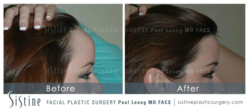 Hair Transplant Before and After | Leong Facial Plastic Surgery