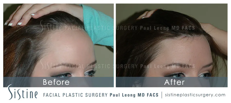 Hair Transplant Before and After | Leong Facial Plastic Surgery