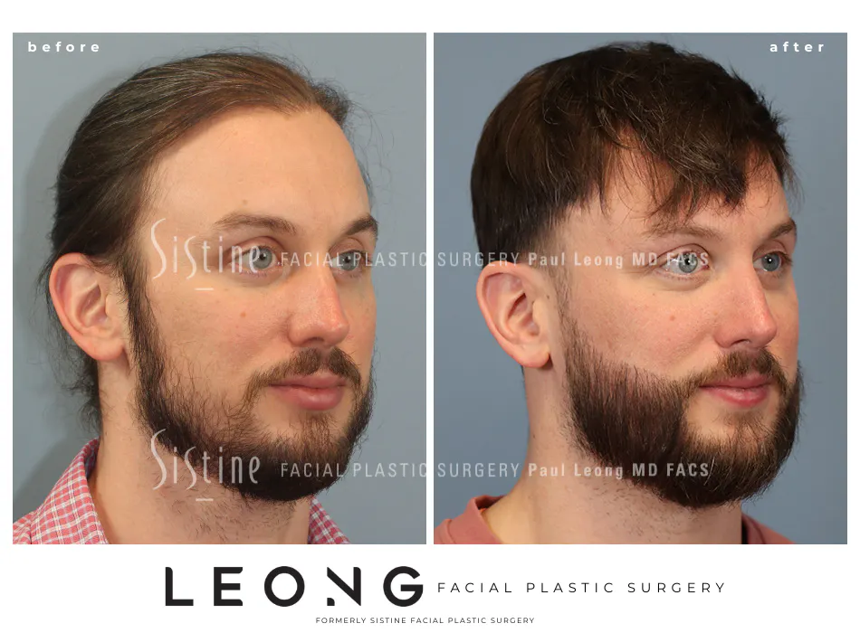 Hair Transplant Before and After | Leong Facial Plastic Surgery