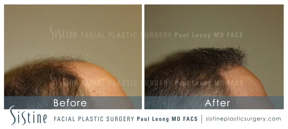 Hair Transplant Before and After | Leong Facial Plastic Surgery