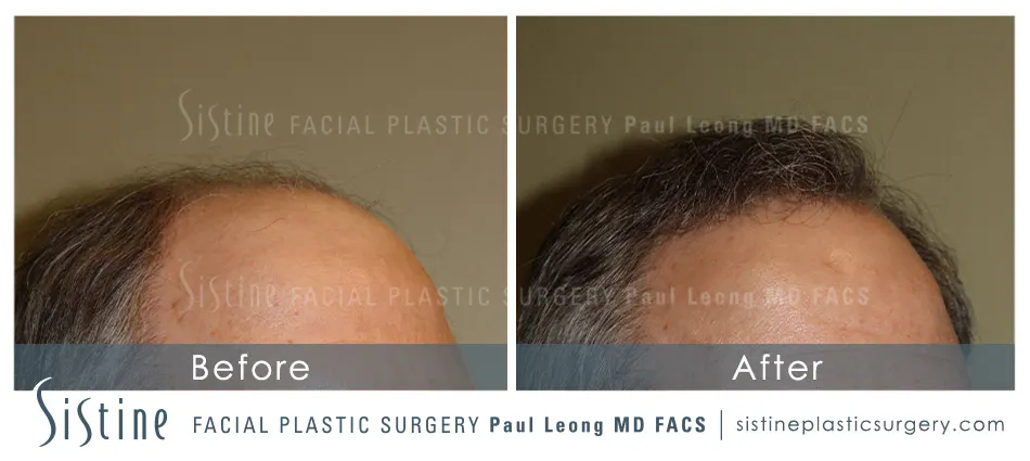 Hair Transplant Before and After | Leong Facial Plastic Surgery