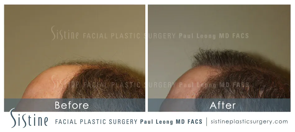 Hair Transplant Before and After | Leong Facial Plastic Surgery