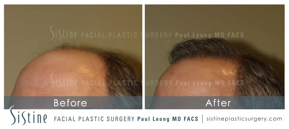 Hair Transplant Before and After | Leong Facial Plastic Surgery
