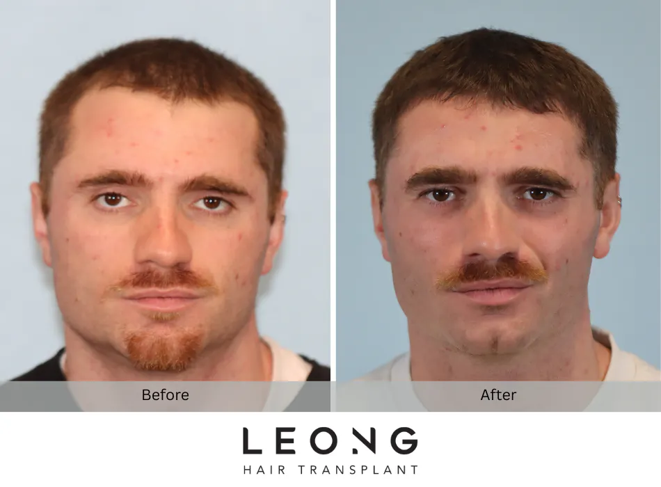 Hair Transplant Before and After | Leong Facial Plastic Surgery