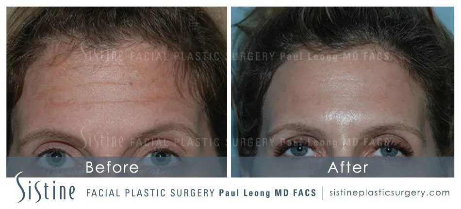 Botox Cosmetic Dysport Before and After | Leong Facial Plastic Surgery