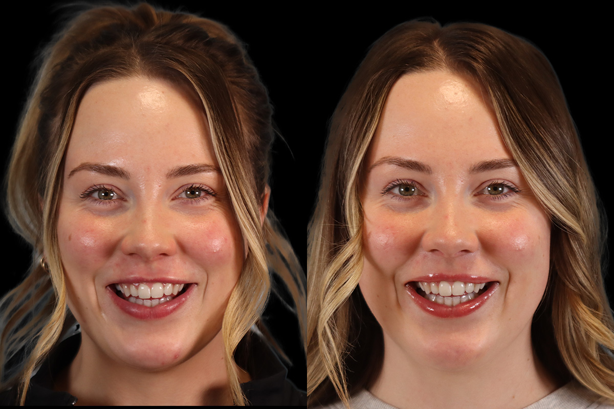 Botox Cosmetic Dysport Before and After | Leong Facial Plastic Surgery