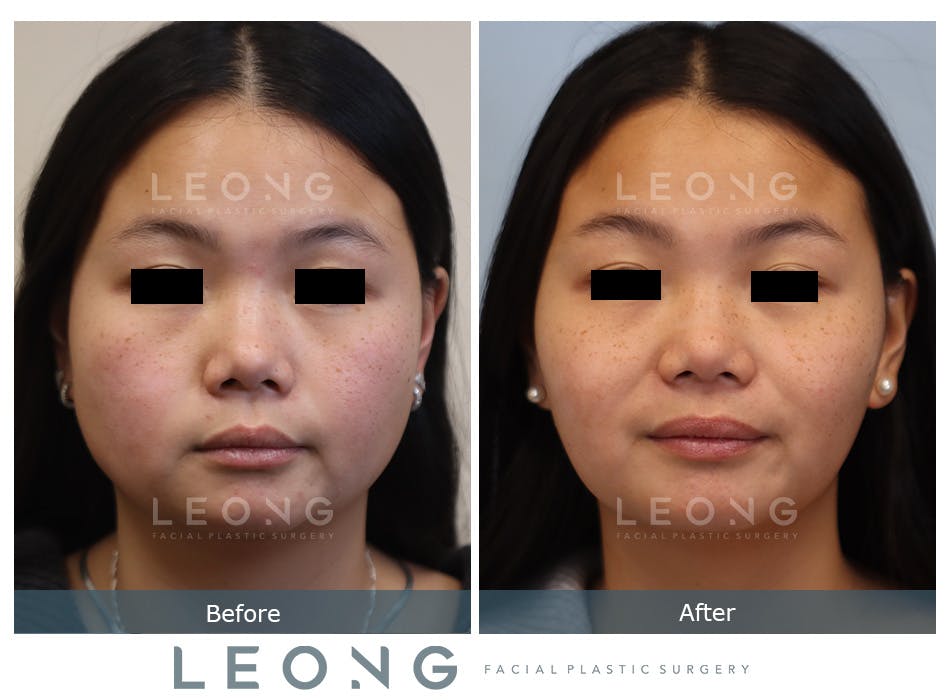 Botox Cosmetic Dysport Before and After | Leong Facial Plastic Surgery
