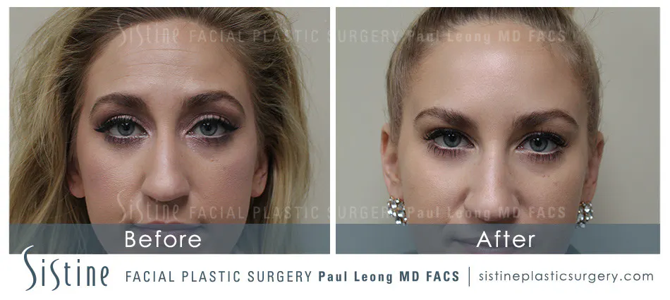 Botox Cosmetic Dysport Before and After | Leong Facial Plastic Surgery