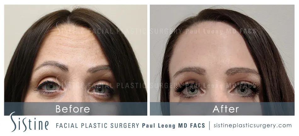 Botox Cosmetic Dysport Before and After | Leong Facial Plastic Surgery