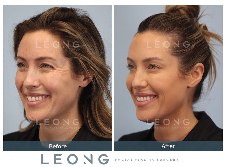 Botox Cosmetic Dysport Before and After | Leong Facial Plastic Surgery