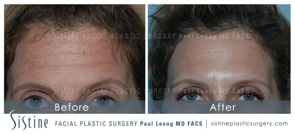 Botox Cosmetic Dysport Before and After | Leong Facial Plastic Surgery