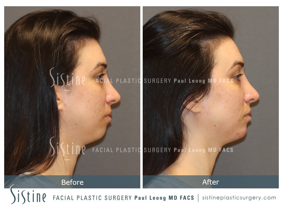 Dermal Fillers Before and After | Leong Facial Plastic Surgery