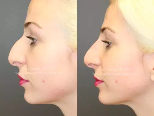 Dermal Fillers Before and After | Leong Facial Plastic Surgery
