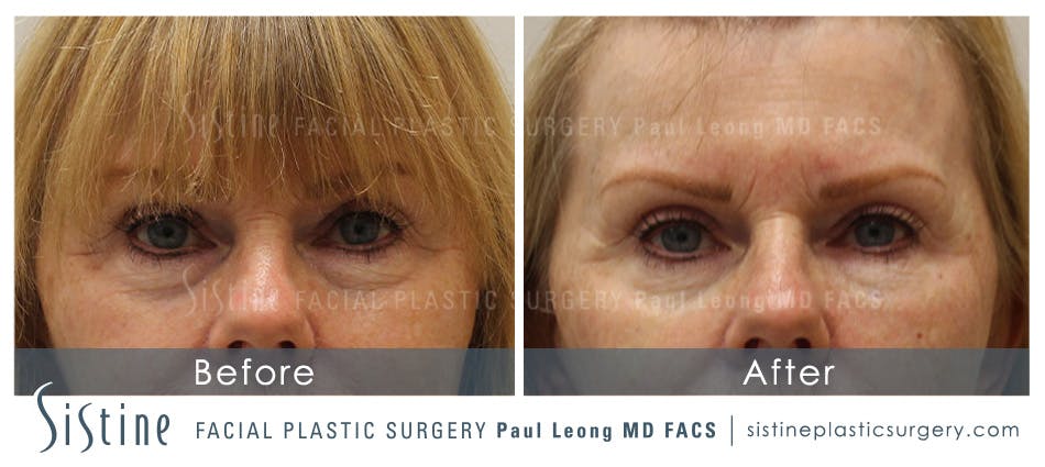 Dermal Fillers Before and After | Leong Facial Plastic Surgery