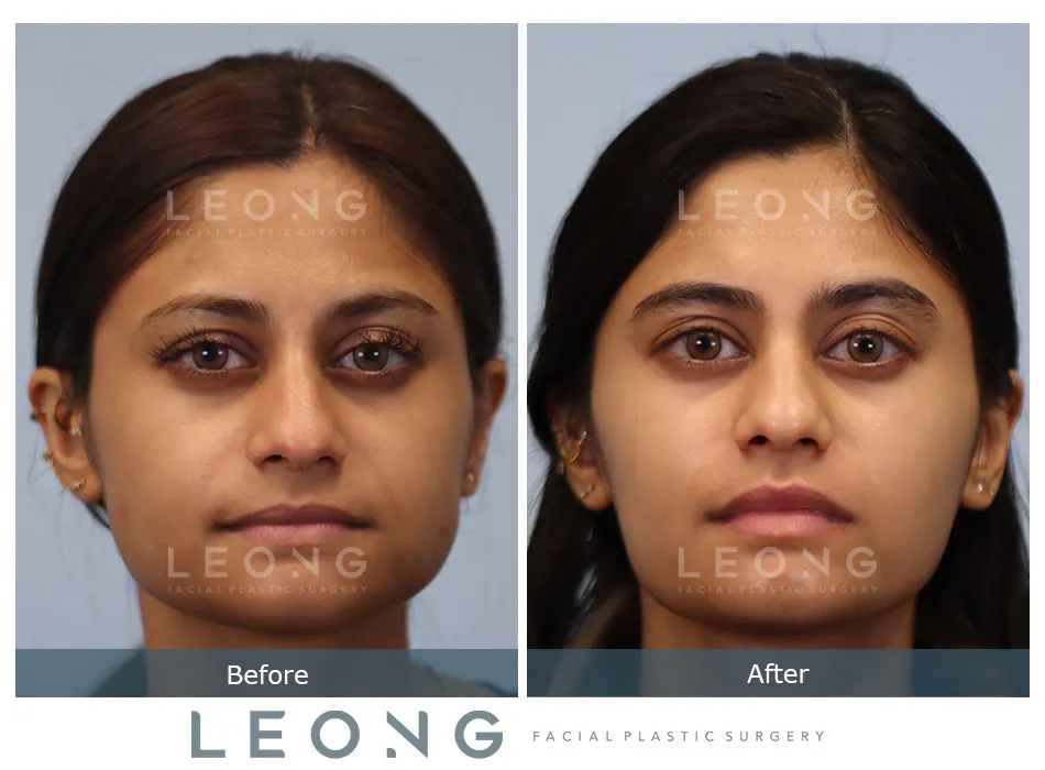 Jawline Slimming Before and After | Leong Facial Plastic Surgery