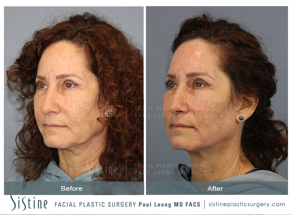 Jawline Slimming Before and After | Leong Facial Plastic Surgery