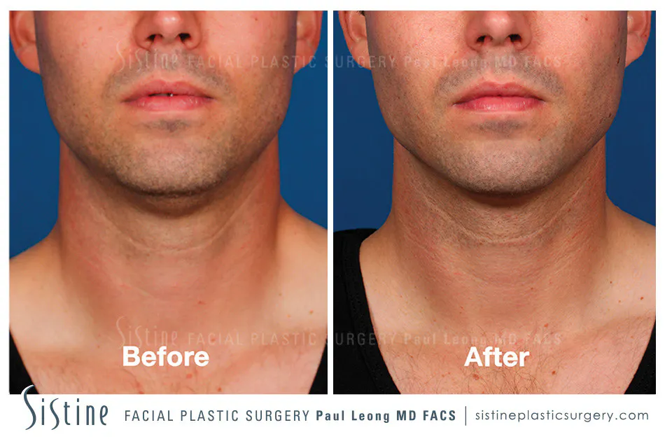 Kybella Before and After | Leong Facial Plastic Surgery