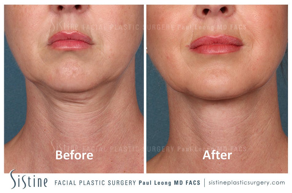 Kybella Before and After | Leong Facial Plastic Surgery