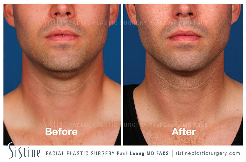 Kybella Before and After | Leong Facial Plastic Surgery