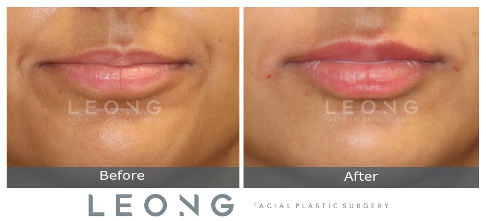 Lip Augmentation Before and After | Leong Facial Plastic Surgery