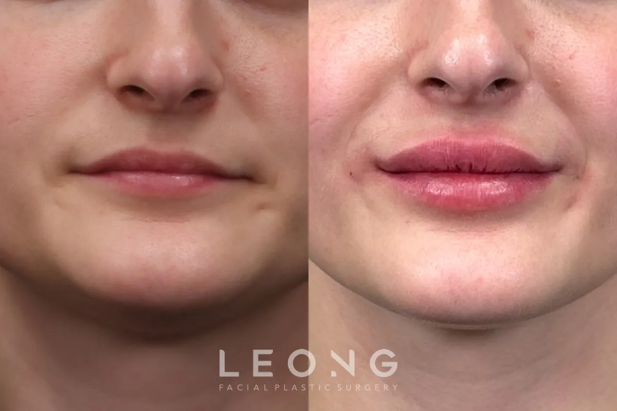 Lip Augmentation Before and After | Leong Facial Plastic Surgery