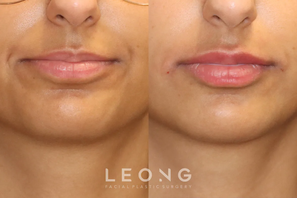 Lip Augmentation Before and After | Leong Facial Plastic Surgery