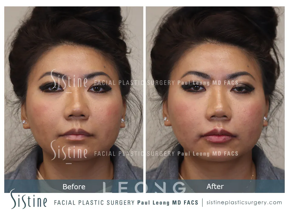 Lip Augmentation Before and After | Leong Facial Plastic Surgery