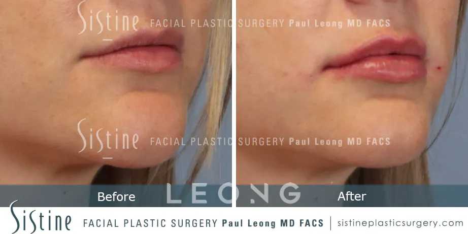 Lip Augmentation Before and After | Leong Facial Plastic Surgery