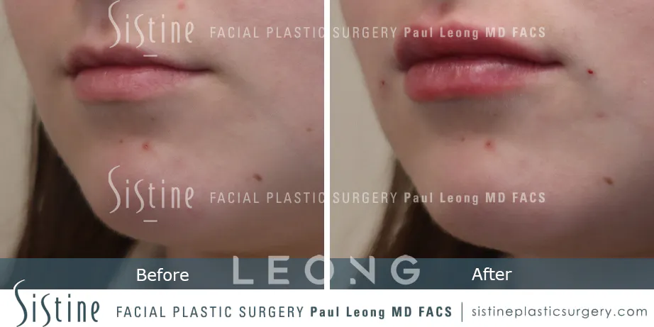 Lip Augmentation Before and After | Leong Facial Plastic Surgery