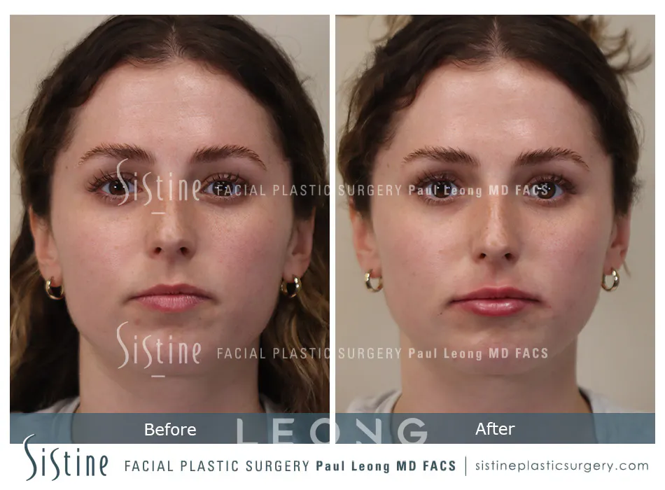 Lip Augmentation Before and After | Leong Facial Plastic Surgery