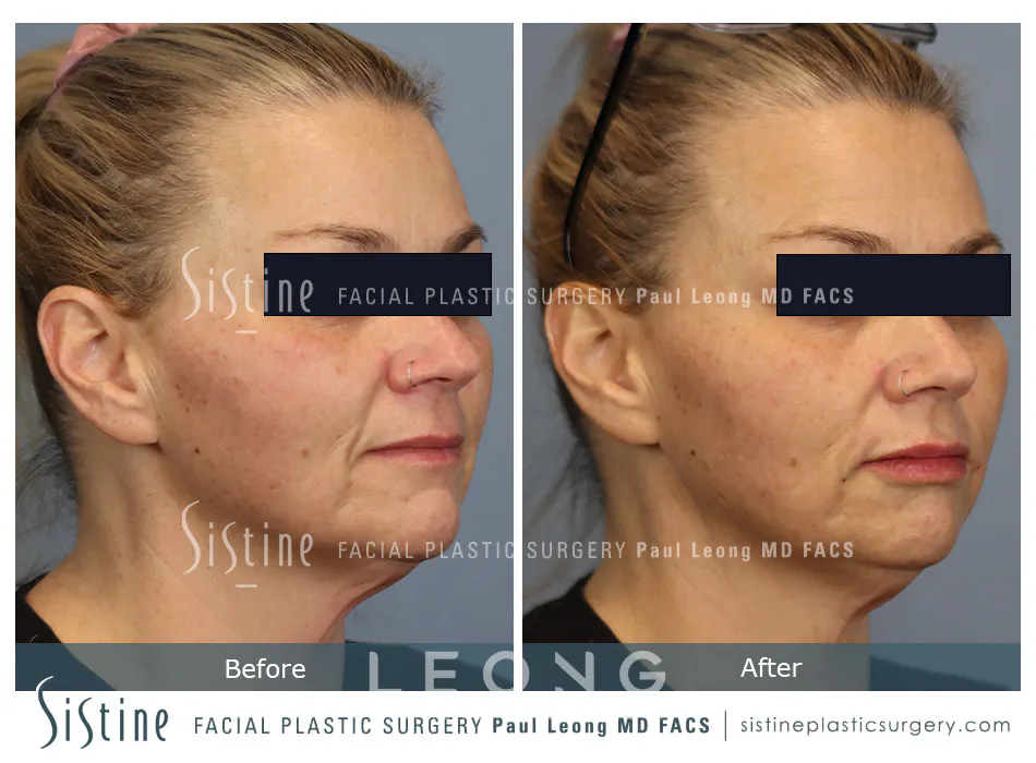 Lip Augmentation Before and After | Leong Facial Plastic Surgery