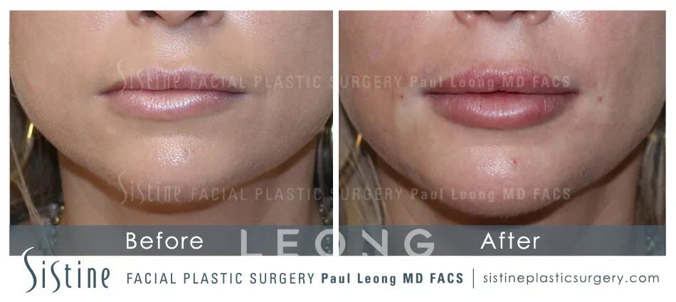Lip Augmentation Before and After | Leong Facial Plastic Surgery