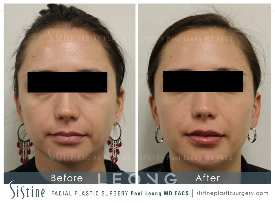 Lip Augmentation Before and After | Leong Facial Plastic Surgery