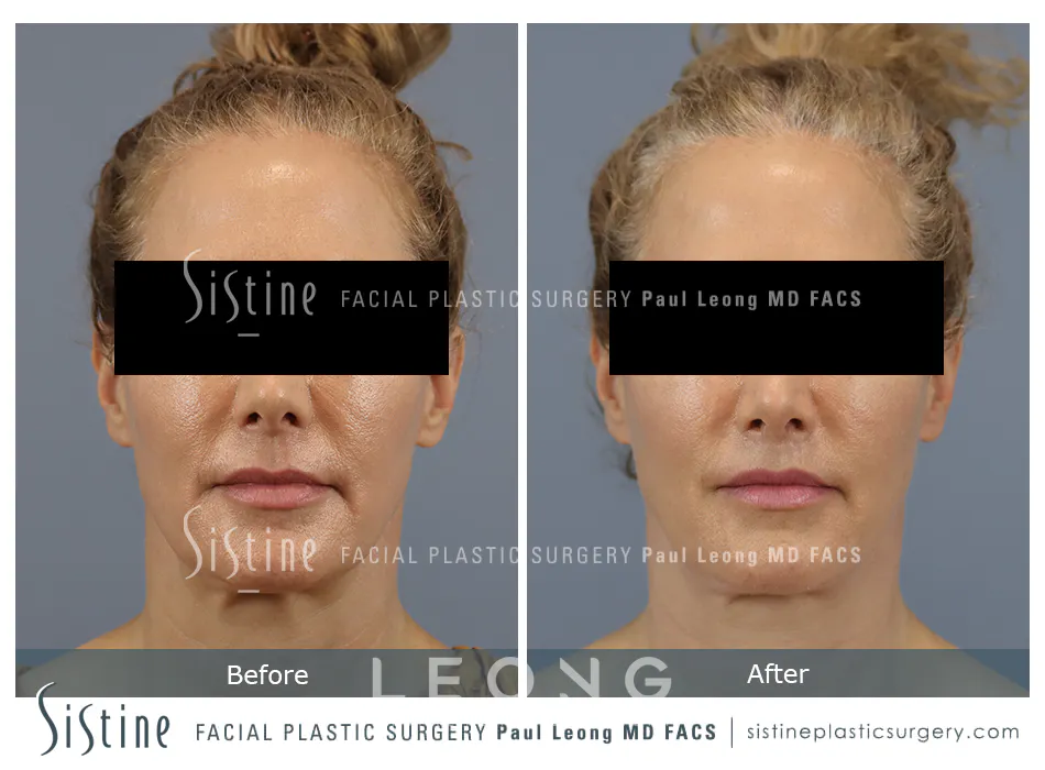 Lip Augmentation Before and After | Leong Facial Plastic Surgery
