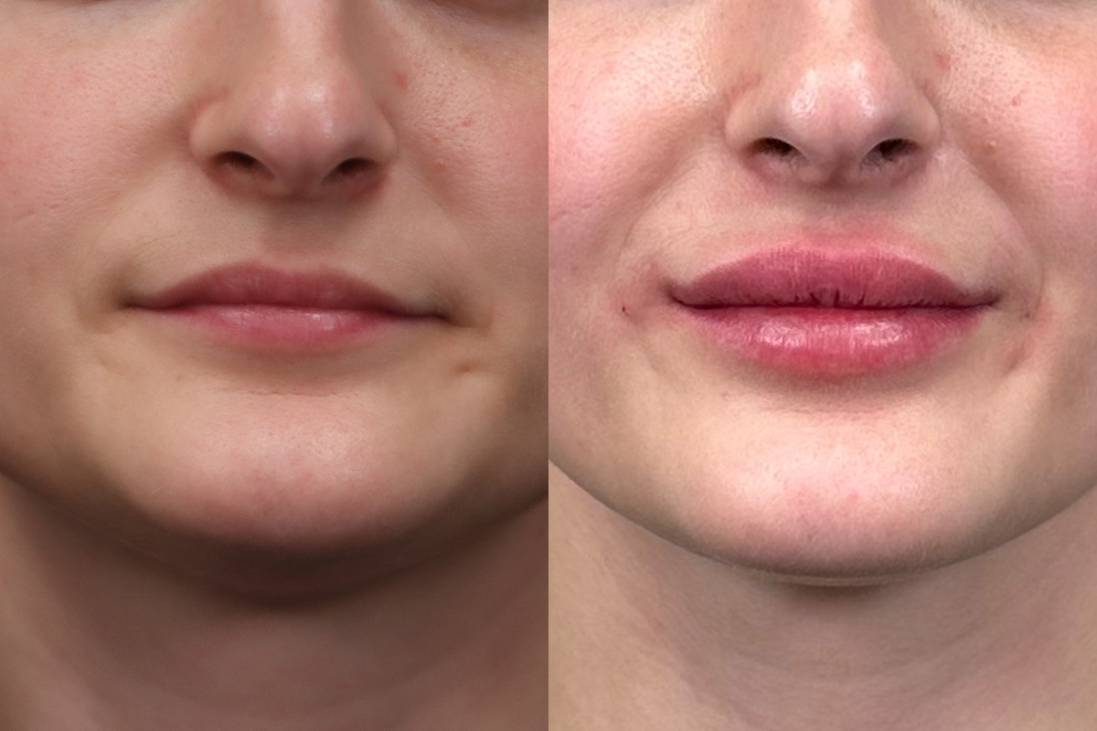 Lip Augmentation Before and After | Leong Facial Plastic Surgery