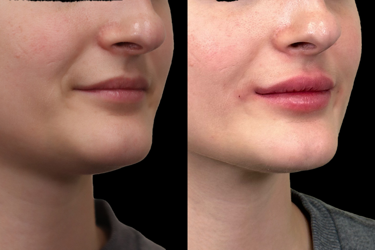 Lip Augmentation Before and After | Leong Facial Plastic Surgery